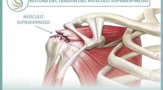 Rotura del  tendón del músculo supraespinoso, información y consejos para su prevención