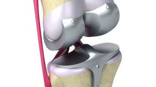 Todo lo que debemos saber sobre las prótesis de rodilla