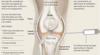 La artritis o inflamación articular, información, consejos y un clarificador vídeo sobre su origen, causas y tratamiento