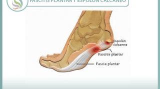 Fascitis plantar y espolón calcáneo, aprende lo que es y como se trata correctamente