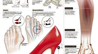 Consecuencias del abuso de los tacones. Daños en el tendón de Aquiles, juanetes, dedo martillo, neuroma de Morton