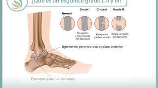 ¿Sabes qué es un esguince de tobillo y cuales son sus grados, según la importancia de la lesión?