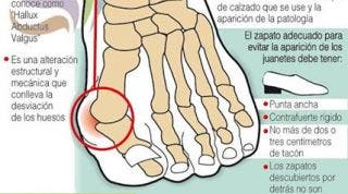 Hallux valgus o juanete, aprende un eficaz automasaje para tratarlo