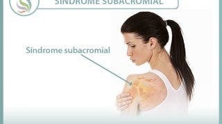 El síndrome subacromial. Aprende qué es, cómo se produce y qué puedes hacer para un correcto tratamiento