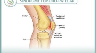 Tratamiento, características, síntomas, causas y mucho mas, sobre el síndrome femoro-patelar