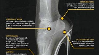 Juanetes, lesiones de tobillo, metatarsalgia, callosidades en el talón, deformidad ósea, consecuencia de los tacones