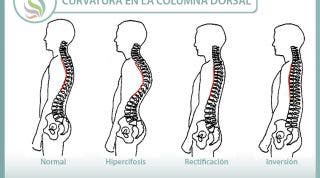 Hipercifosis, aprende que es y como corregirla