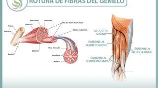 Rotura de fibras del gemelo o gastrocnemio, una lesión frecuente