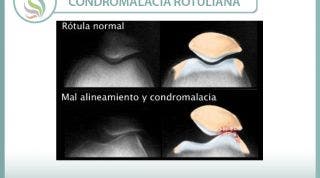 Condromalacia o condropatía rotuliana, causas, y tratamiento de una alteración mecánica