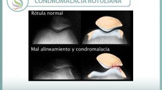 Condromalacia o condropatía rotuliana, causas, y tratamiento de una alteración mecánica Condromalacia o condropatía rotuliana, causas, y tratamiento de una alteración mecánica