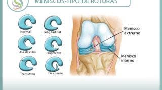 No hay dos rodillas iguales, ni dos lesiones de menisco iguales, aprende algunas diferencias