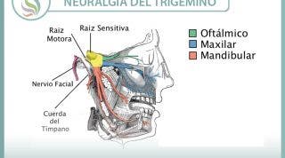 Neuralgia del trigémino. Un problema complejo