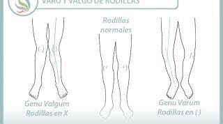 Rodillas varas o valgas. Dos alteraciones posturales y dos ejercicios para trabajarlas