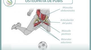 Entendiendo la osteopatía de pubis o pubalgia del futbolista