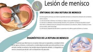 Lesión y rotura de Menisco: Consejos y tratamiento fisioterapéutico