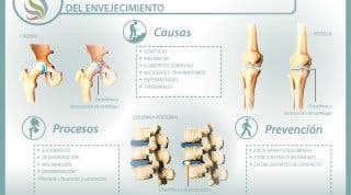 La artrosis, una visión como consecuencia del envejecimiento