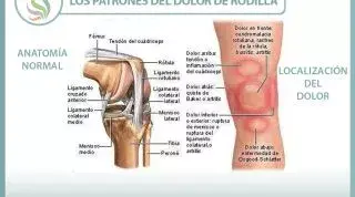 Los patrones del dolor de rodilla o gonalgia y las lesiones más comunes