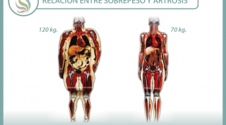 Sobrepeso y artrosis