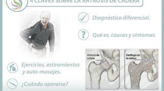 4 claves sobre la artrosis de cadera