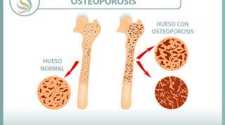 Explicando la osteoporosis