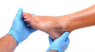 Fisioterapia y prevención en el pie diabético