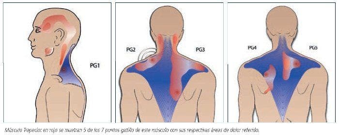 Cefalea tensional y puntos gatillo miofasciasles. Incidencia y relación