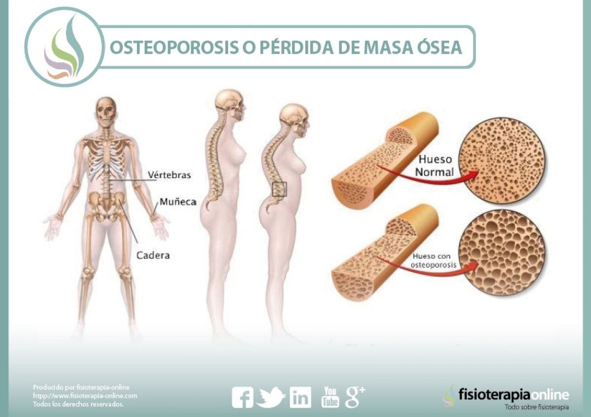 La osteoporosis o pérdida de masa ósea. Un grave problema de los huesos