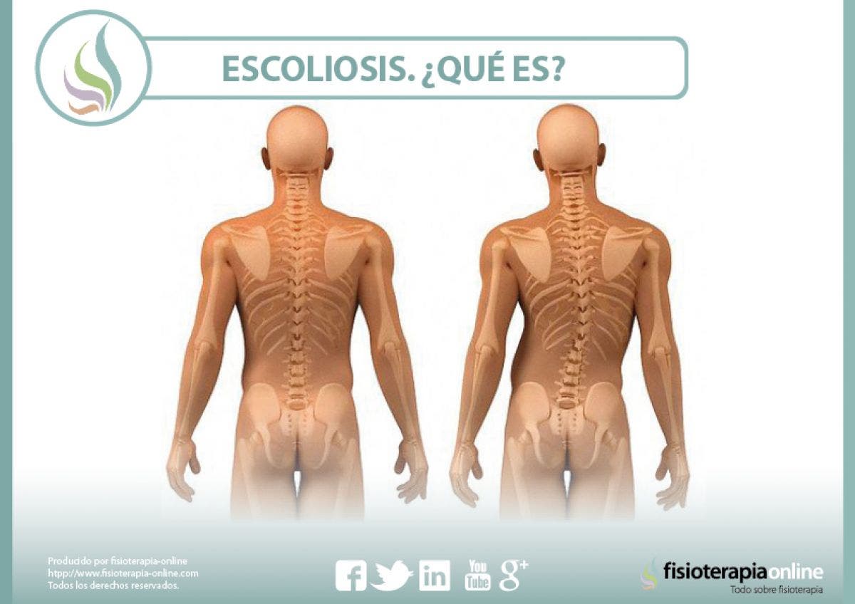 Escoliosis ¿Qué es? Tipos, causas y tratamiento