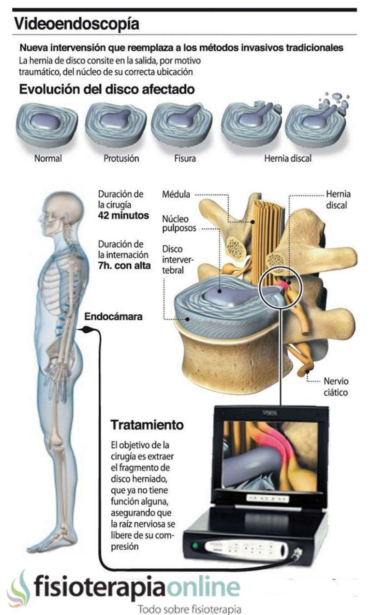 El avance de la videoendoscopia 