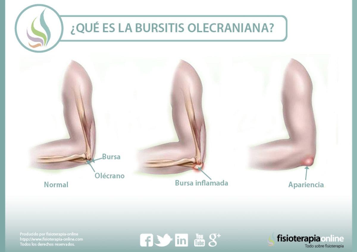 Descubriendo la bursitis olecraniana