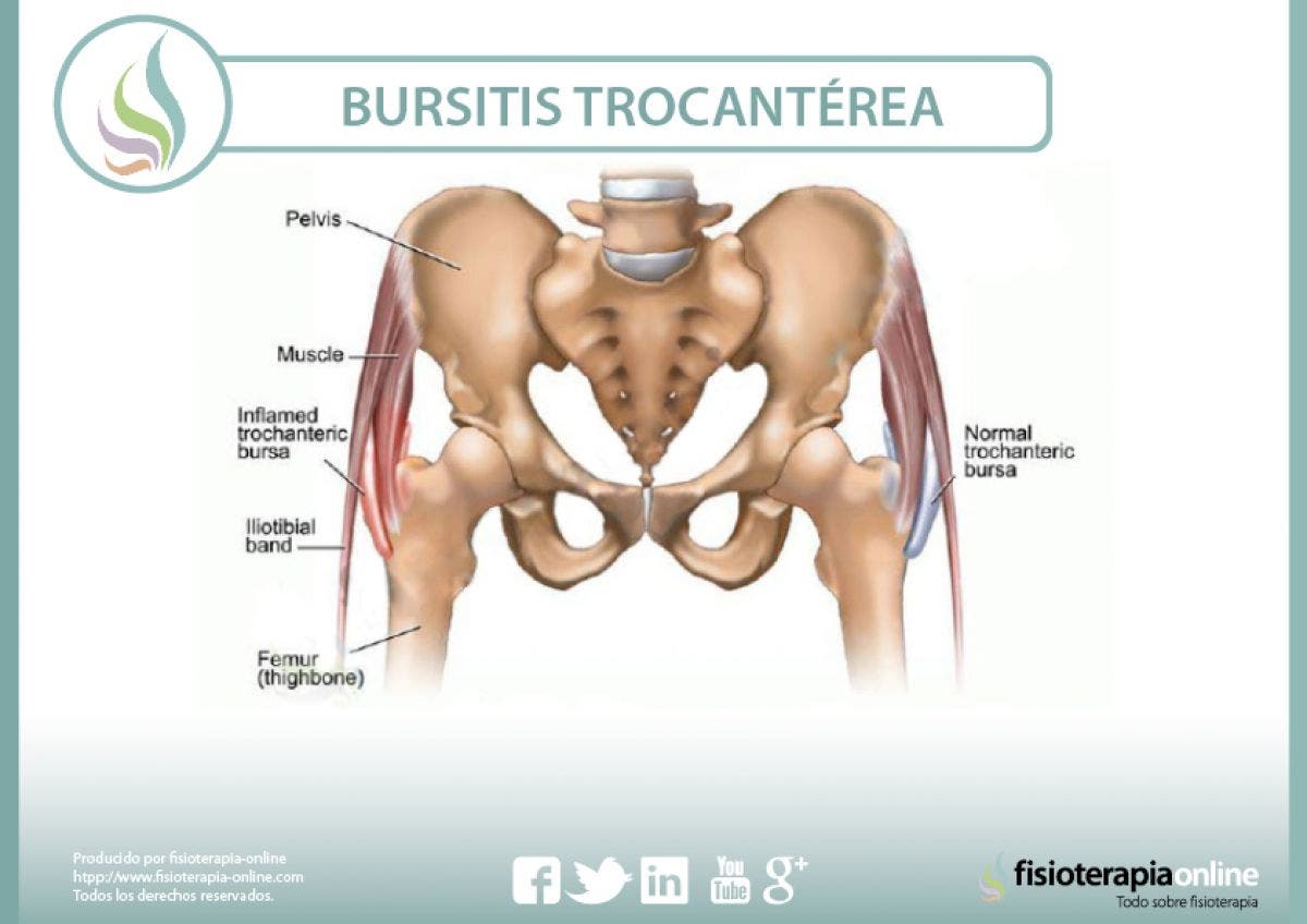 Conoce la bursitis trocantérea o trocanteritis