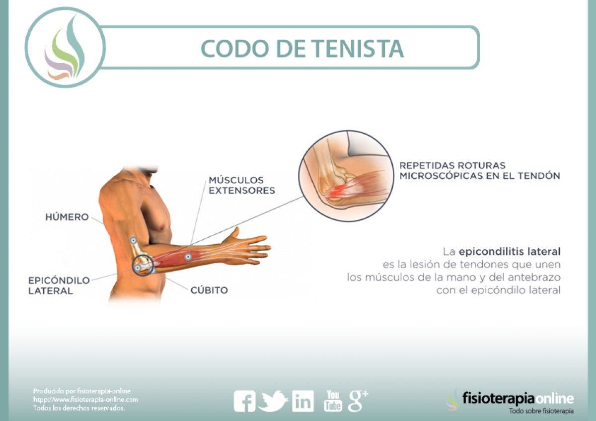 Epicondilitis, epicondilalgia, el martirizante codo de tenista