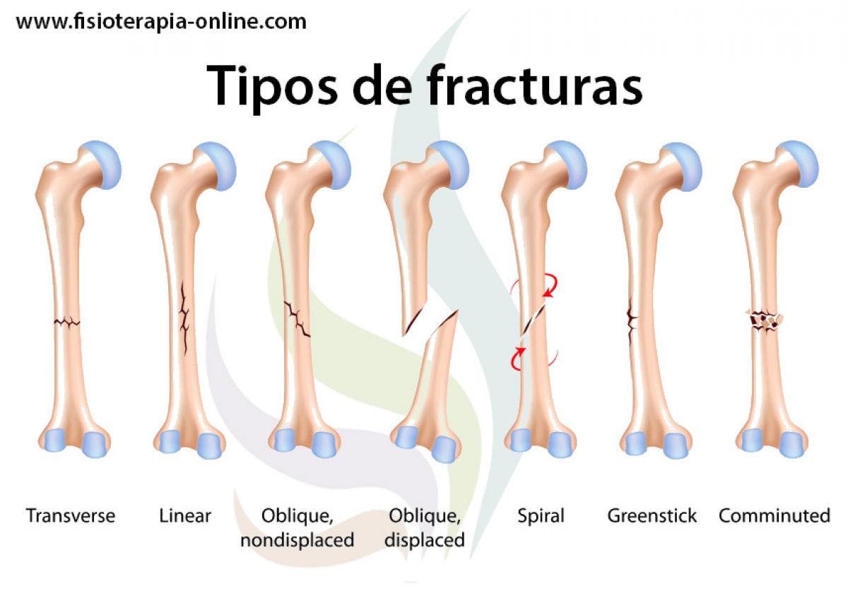 Fracturas óseas, tipos, cuidados y tratamiento | Fisioterapia Online