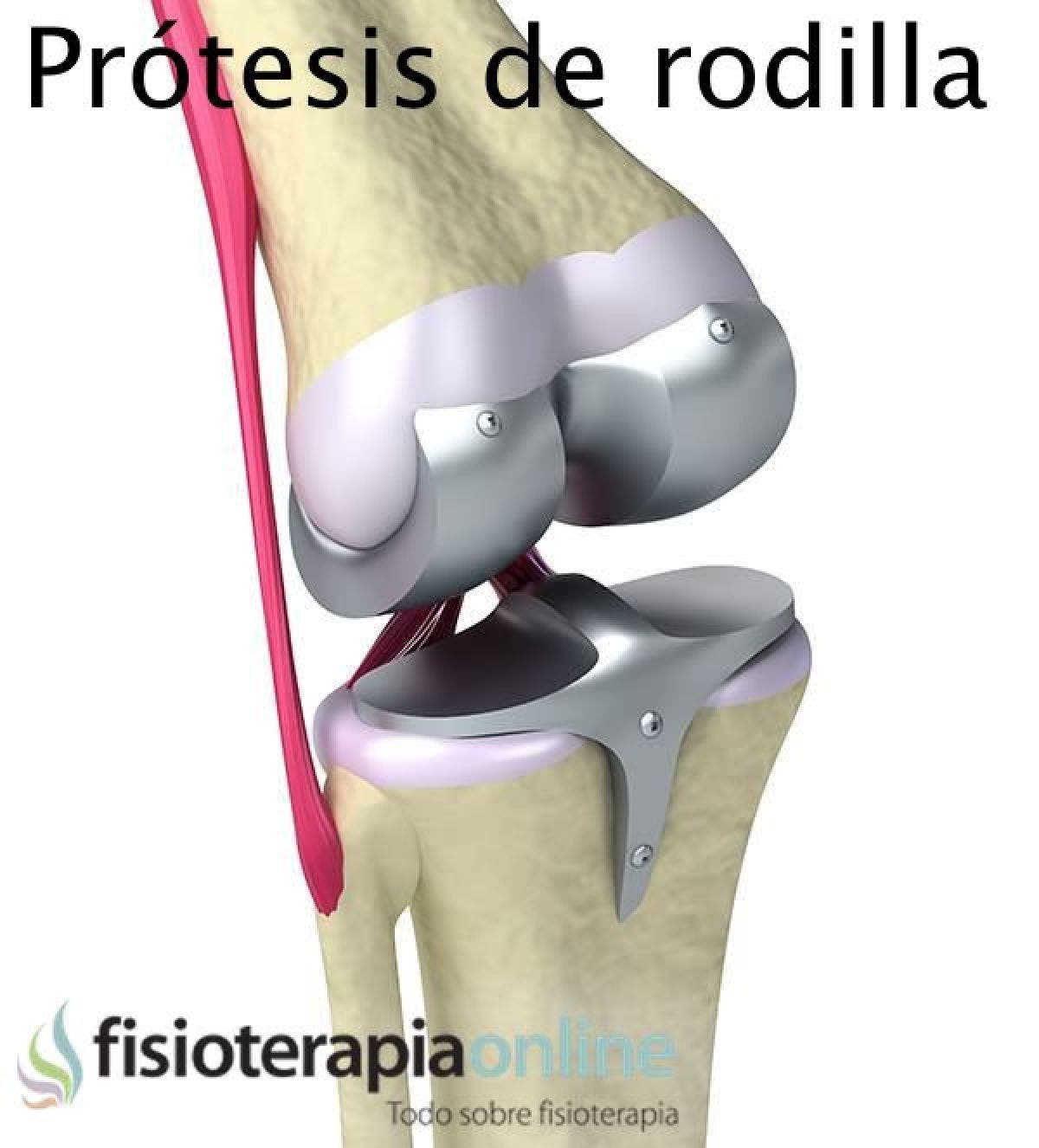 Todo lo que debemos saber sobre las prótesis de rodilla