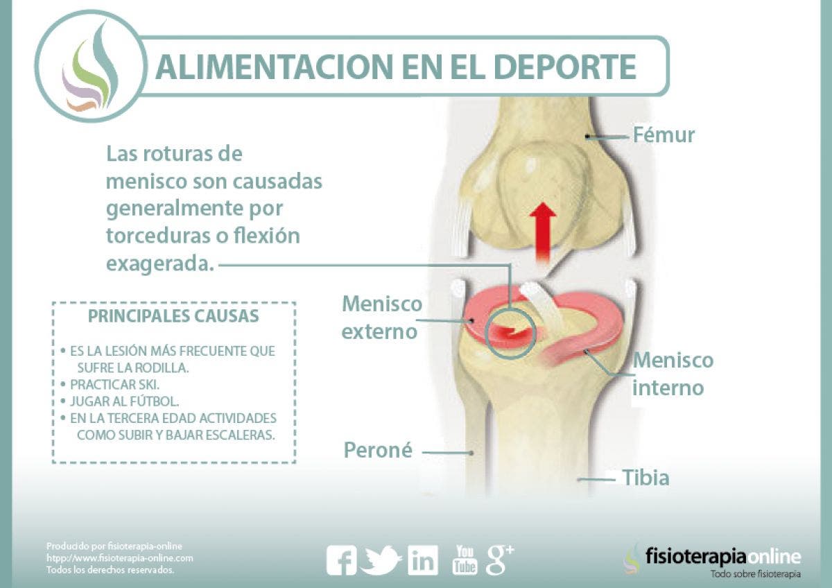 Conoce lo que supone una rotura de menisco, sus causas, consecuencias y tratamiento