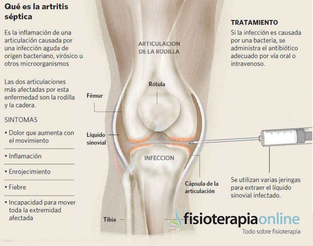 artritis bacteriana sintomas ce tratament se ia pentru picioare umflate