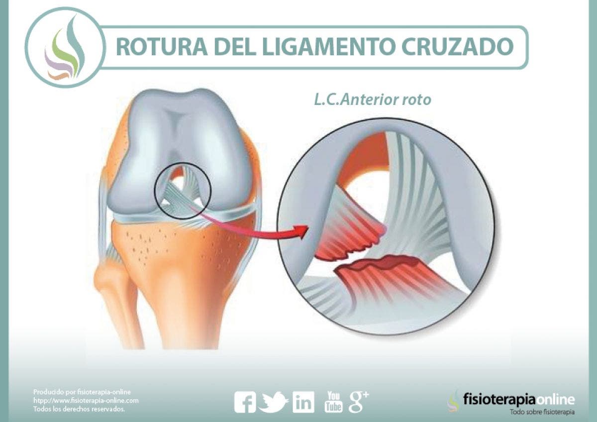 Rotura del ligamento cruzado de la rodilla, información consejos y un útil vídeo sobre el tema