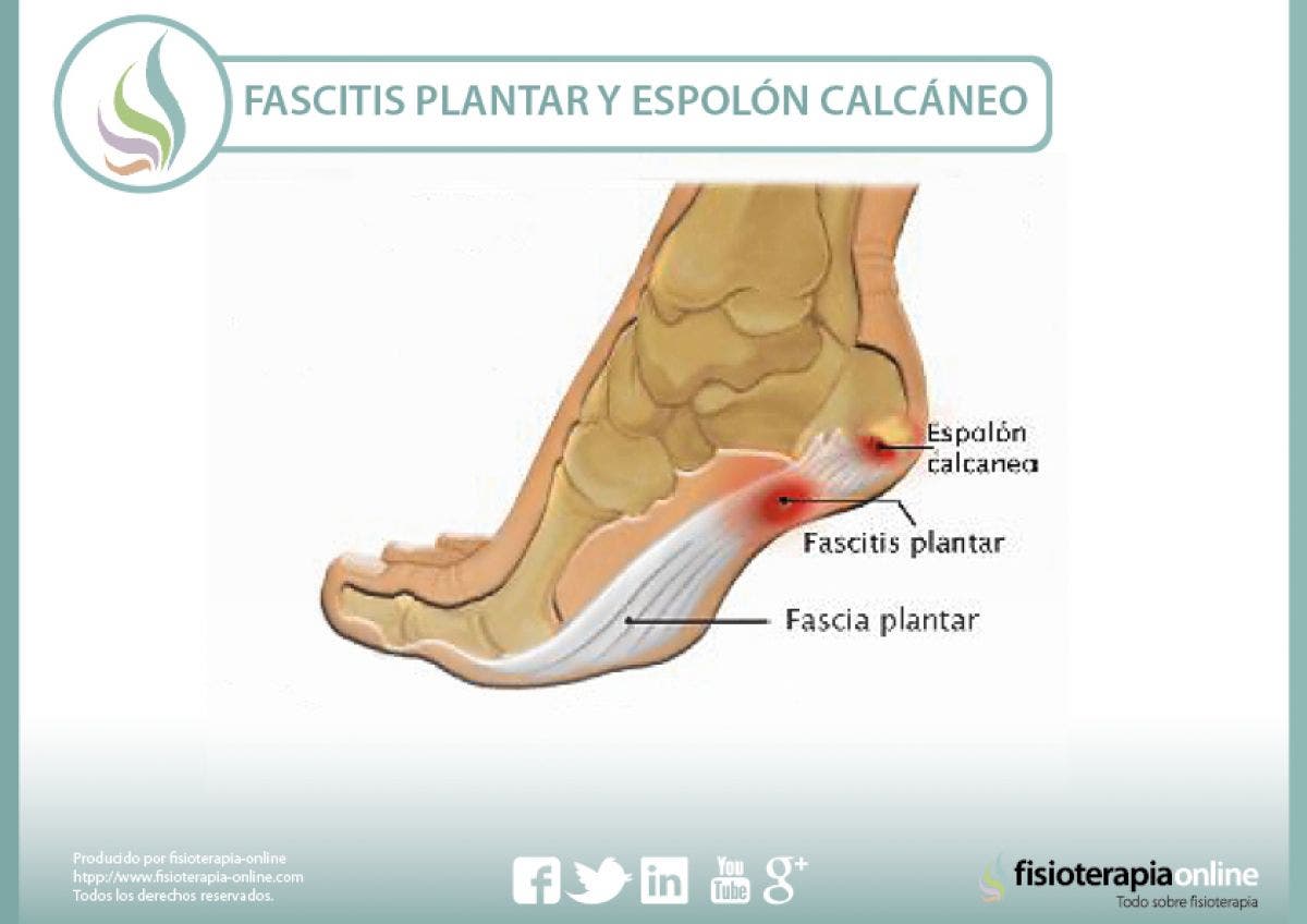 Fascitis plantar y espolón calcáneo, aprende lo que es y como se trata correctamente