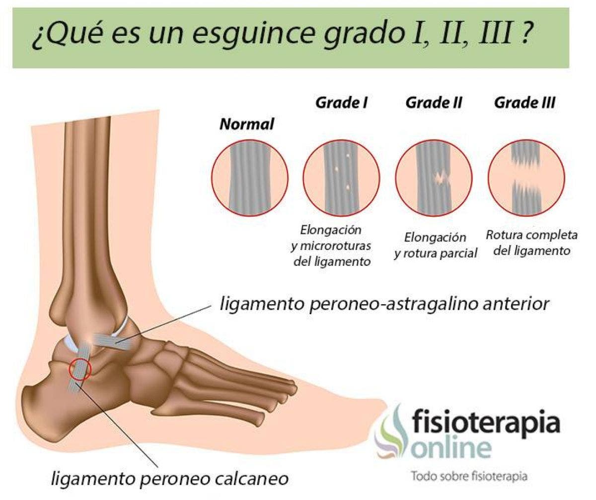 ¿ Sabes qué es un esguince de tobillo y cuales son sus grados, según la importancia de la lesión