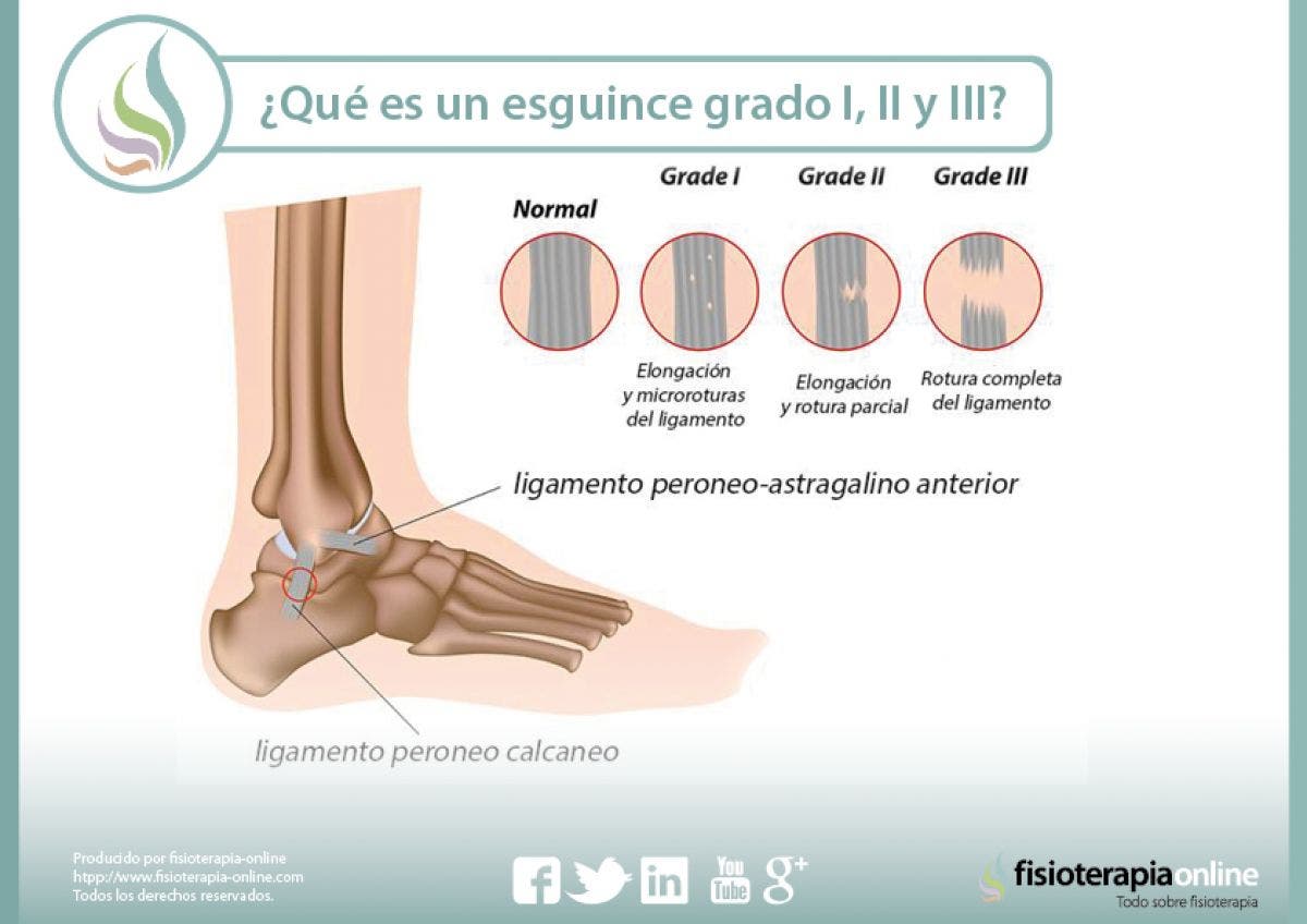 ¿Sabes qué es un esguince de tobillo y cuales son sus grados, según la importancia de la lesión?