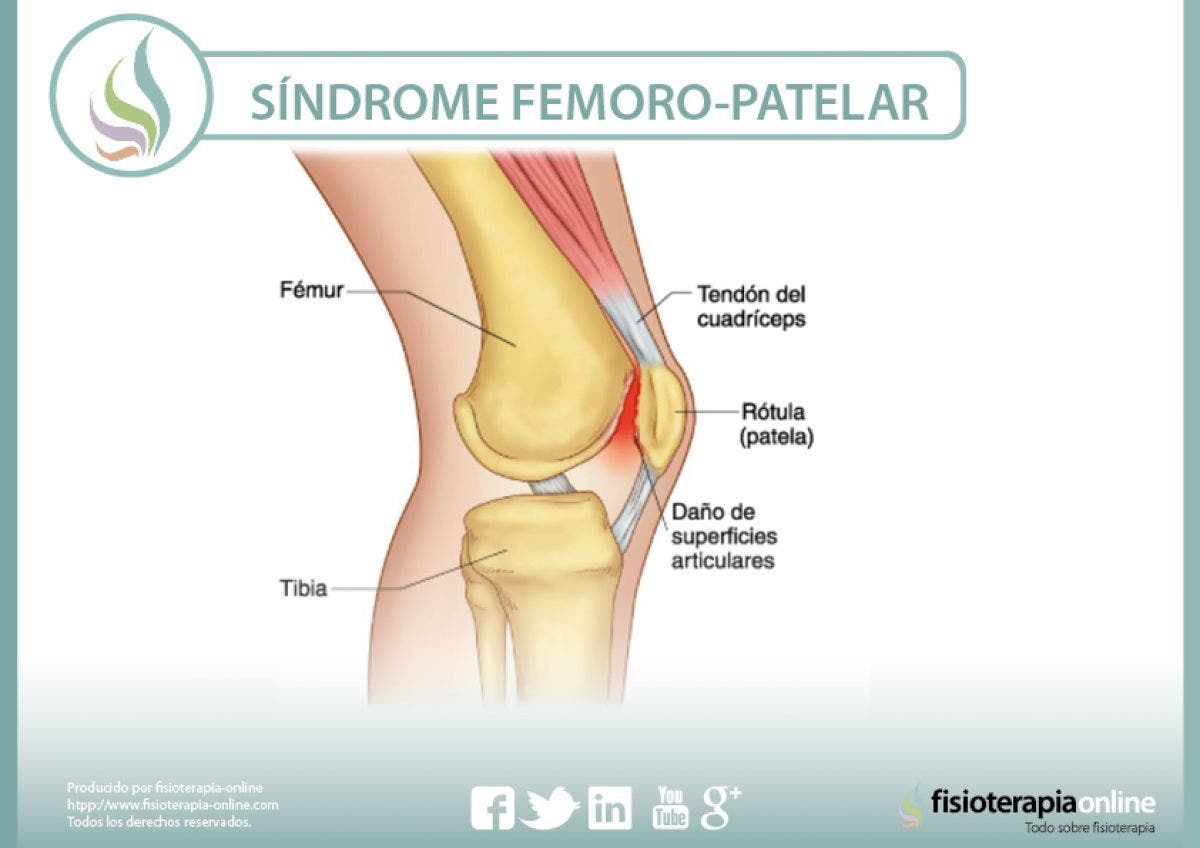 Tratamiento, características, síntomas, causas y mucho mas, sobre el síndrome femoro-patelar