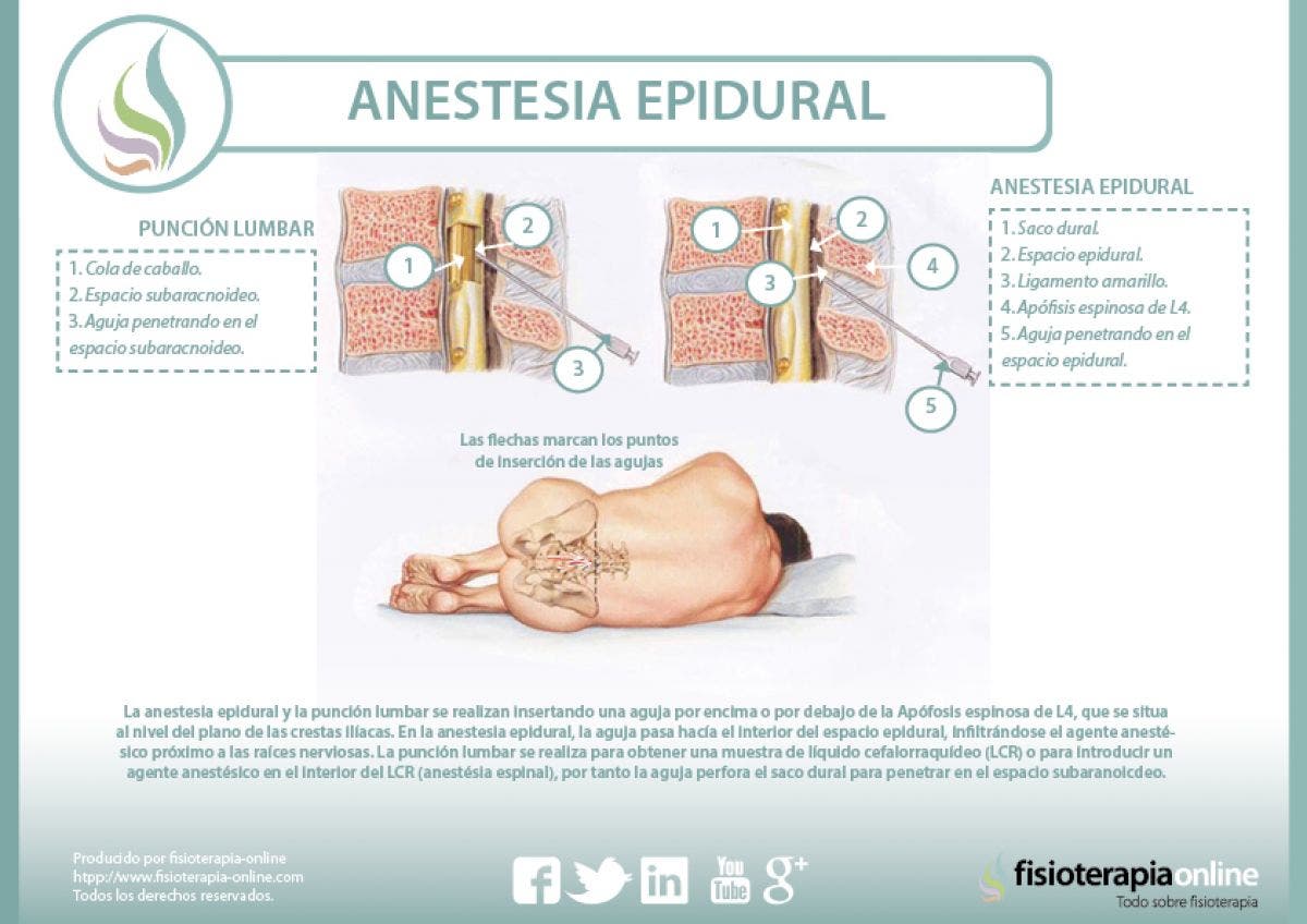 Anestesia epidural, descubre sus indicaciones y sus peligros