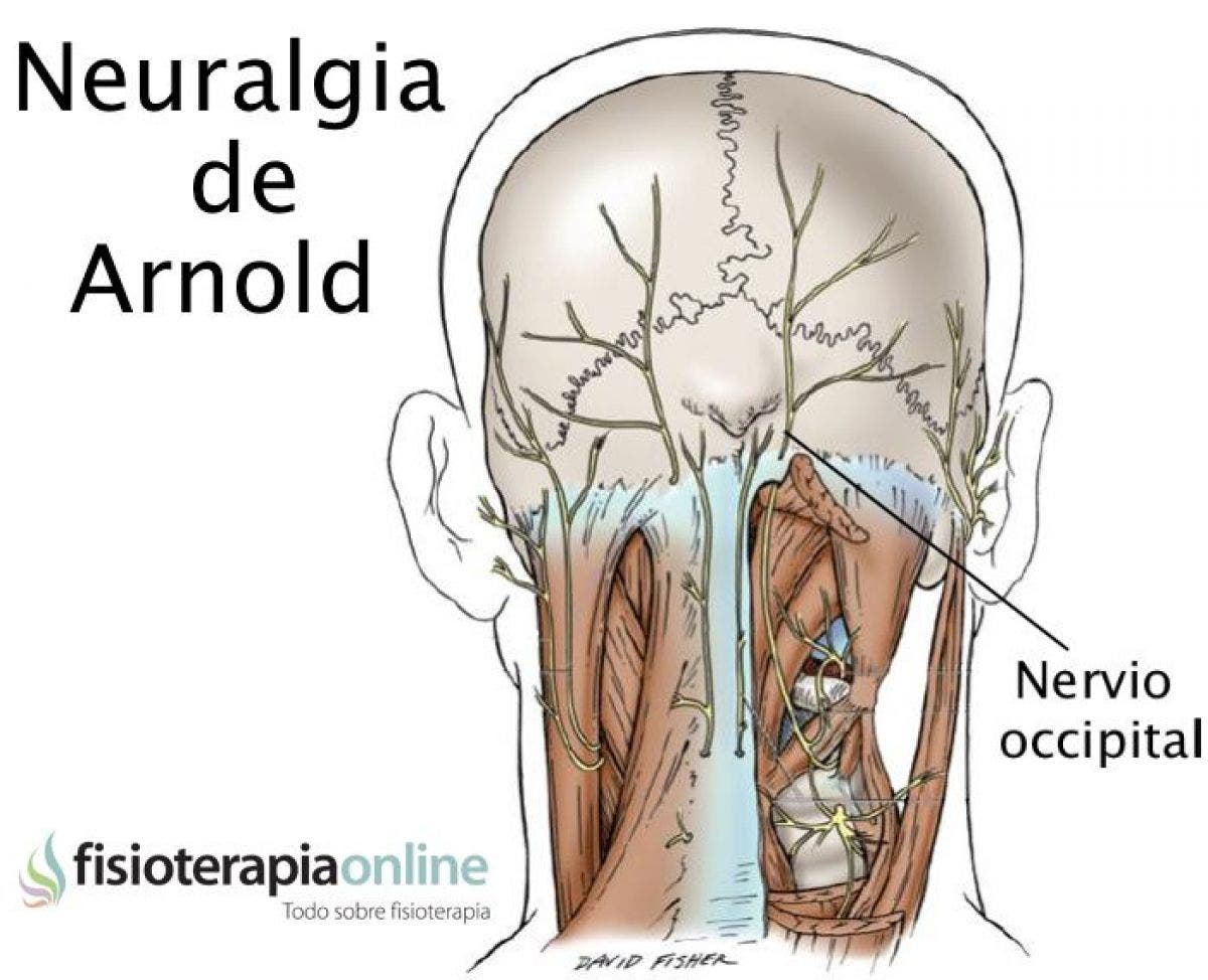 Neuralgia u occipitalgia de Arnold. Descubre sus causas, consecuencias ...