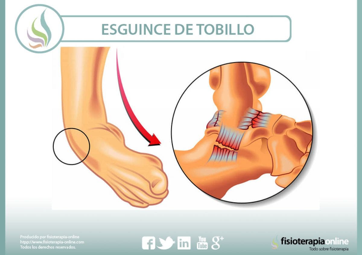 Esguince o torcedura de tobillo - 29 vídeos sobre esta lesión