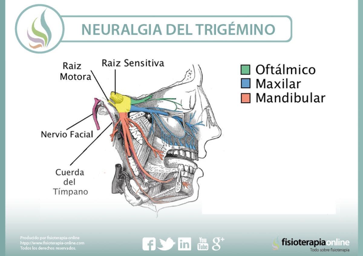 Neuralgia del trigémino. Un problema complejo