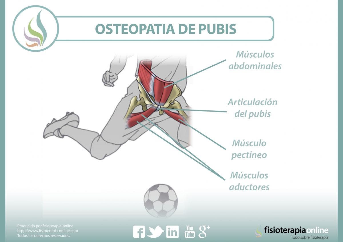 Entendiendo la osteopatía de pubis o pubalgia del futbolista