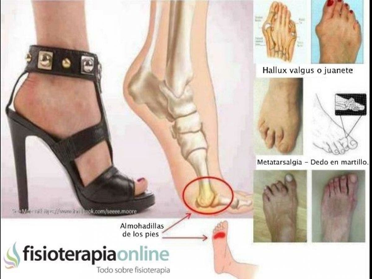 Dolor metatarso top tacones