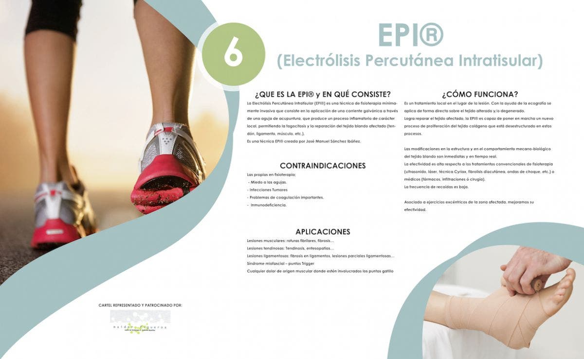 Electrolisis Percutanea Intratisular. ¿Qué es y qué puede hacer para ayudarte con tus lesiones?