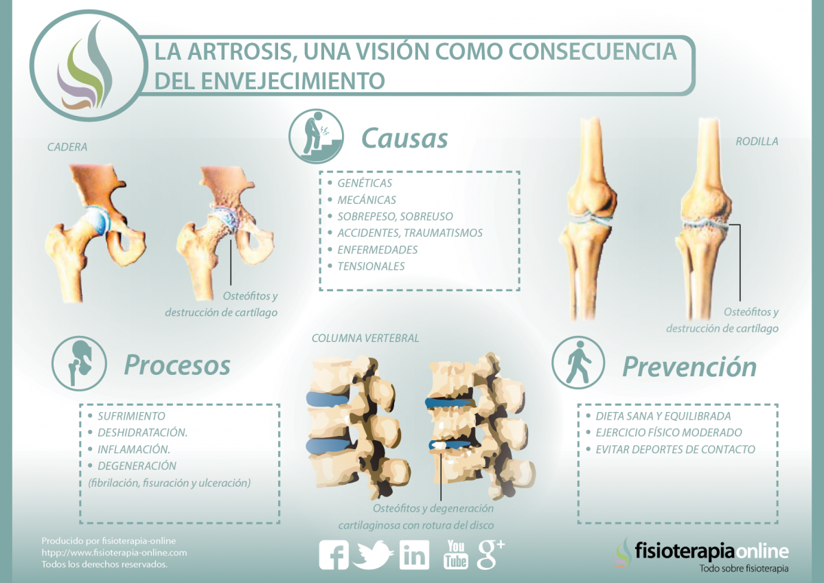 La artrosis, una visión como consecuencia del envejecimiento