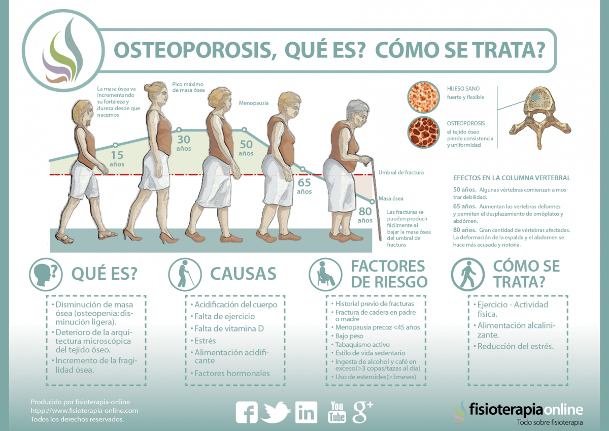 Descubre qué es y cómo se trata la osteoporosis u osteopenia